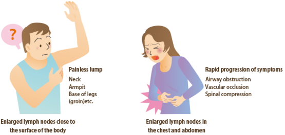 Symptoms of malignant lymphoma