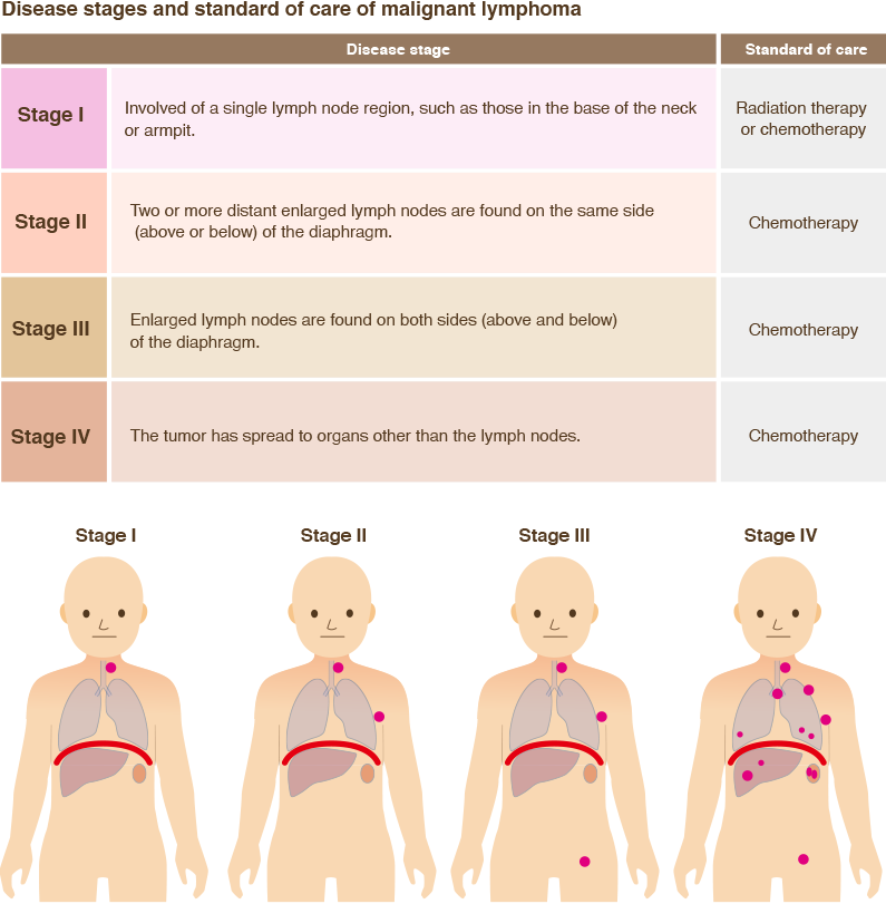 Stages and standard treatment of malignant lymphoma